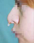 隆鼻術の写真　プロテーゼ　修正